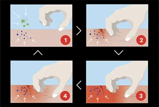four stages of skin inflammation